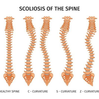 Scoliosis - The Curvature Challenge